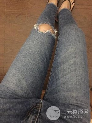 珠海萊茵門(mén)診部盧剛給我做的大腿抽脂手術(shù)，前后對(duì)比圖分享