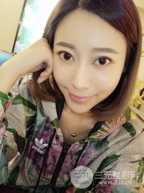 埋埋蛋白線.提升真實(shí)案例分享，珠海萊茵門診部馬中衛(wèi)醫(yī)生做的