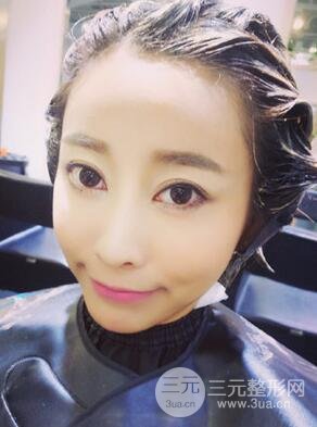 埋埋蛋白線.提升真實(shí)案例分享，珠海萊茵門診部馬中衛(wèi)醫(yī)生做的