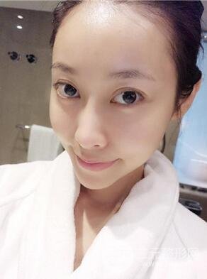 埋埋蛋白線.提升真實(shí)案例分享，珠海萊茵門診部馬中衛(wèi)醫(yī)生做的