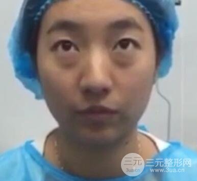 微創(chuàng)內(nèi)切去眼袋手術(shù)價格和恢復(fù)過程圖案例