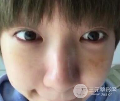 微創(chuàng)內(nèi)切去眼袋手術(shù)價格和恢復(fù)過程圖案例