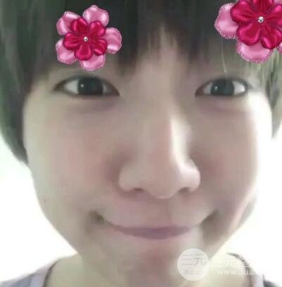 微創(chuàng)內(nèi)切去眼袋手術(shù)價格和恢復(fù)過程圖案例