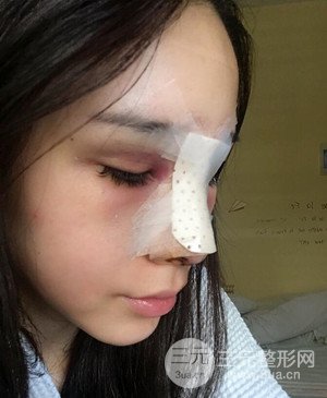 武漢美都張召醫(yī)生給我做的隆鼻整形手術(shù)，給大家分享一下前后照片