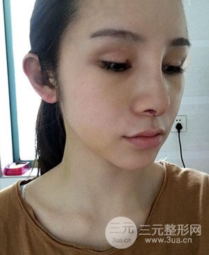 武漢美都張召醫(yī)生給我做的隆鼻整形手術(shù)，給大家分享一下前后照片