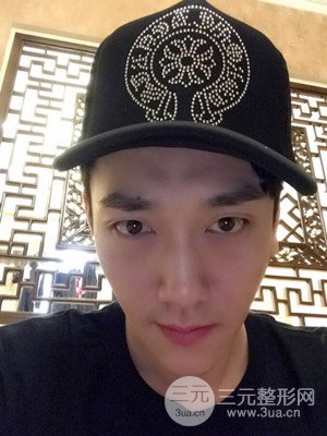 深圳南西子袁新平醫(yī)生給我做的祛眼袋手術，真實案例以及前后對比照片分享