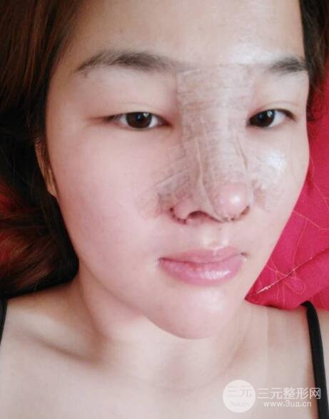 蒜頭鼻整形價(jià)格和對比照片案例