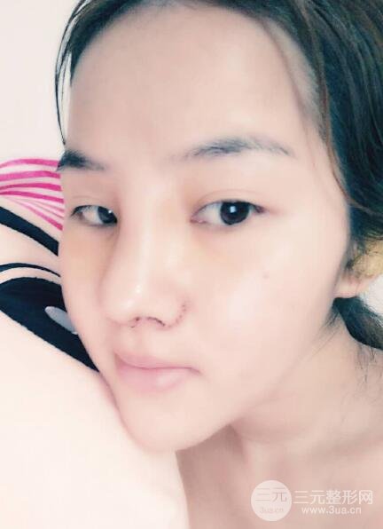 蒜頭鼻整形價(jià)格和對比照片案例