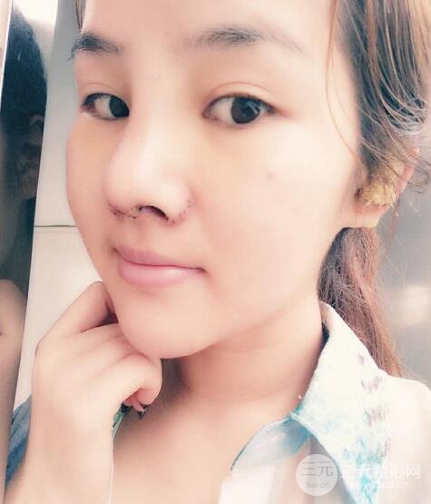 蒜頭鼻整形價(jià)格和對比照片案例