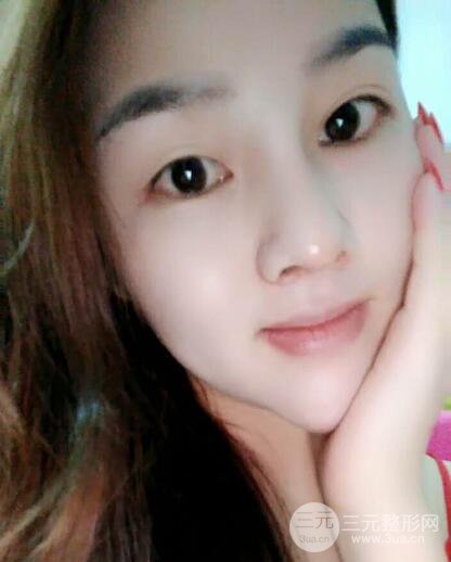 蒜頭鼻整形價(jià)格和對比照片案例