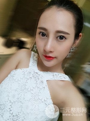 隆鼻失敗修復(fù)手術(shù)真實(shí)案例以及前后對(duì)比圖——青?？等A馮相周醫(yī)生做的