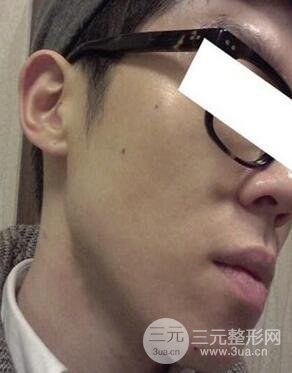 汕頭愛麗諾時慧醫(yī)生給我做的祛痘，看看前后果如何