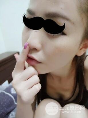 埋埋蛋白線.提升真實案例分享：汕頭愛麗諾時慧醫(yī)生做的