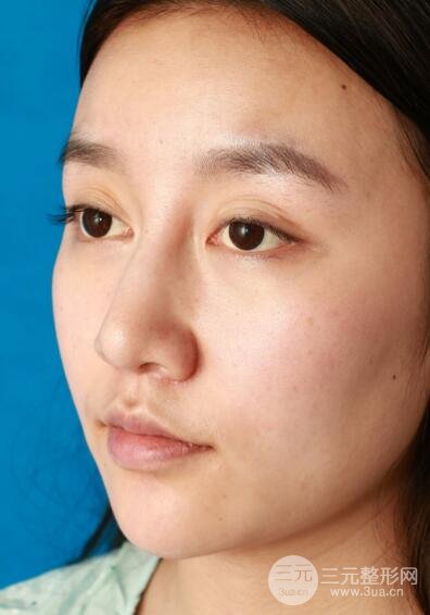 深圳源美做隆鼻失敗修復(fù)價格案例