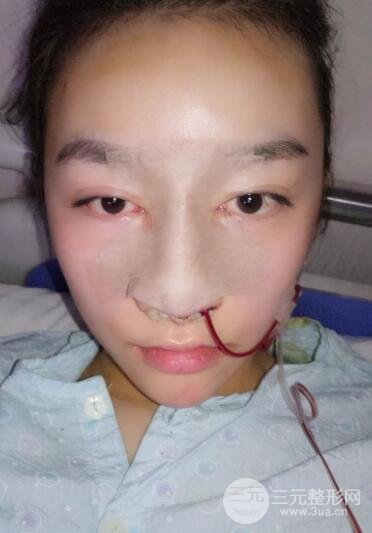 深圳源美做隆鼻失敗修復(fù)價格案例