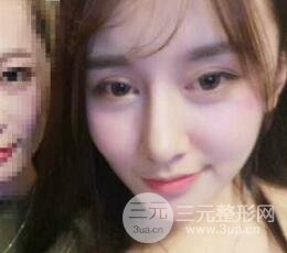 深圳源美做隆鼻失敗修復價格案例