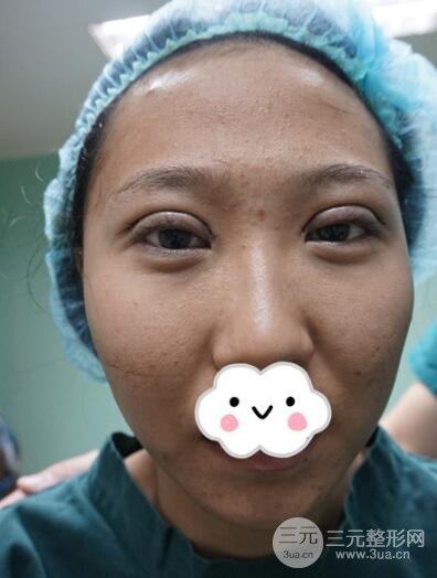 切開雙眼皮無疤痕增生果好圖片案例分享