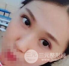 切開雙眼皮無疤痕增生果好圖片案例分享