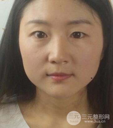 單眼皮割雙眼皮成功案例圖片