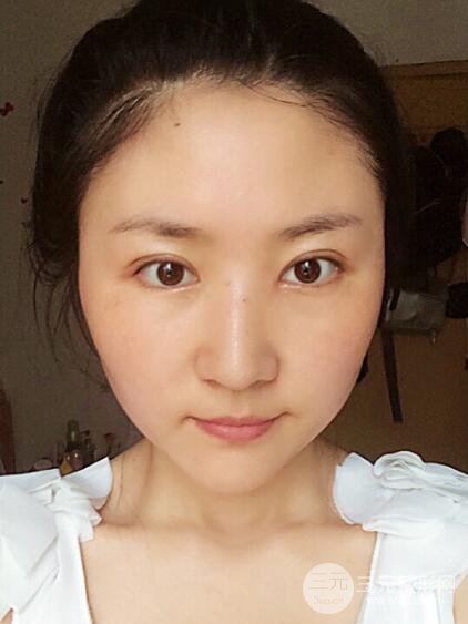 單眼皮割雙眼皮成功案例圖片