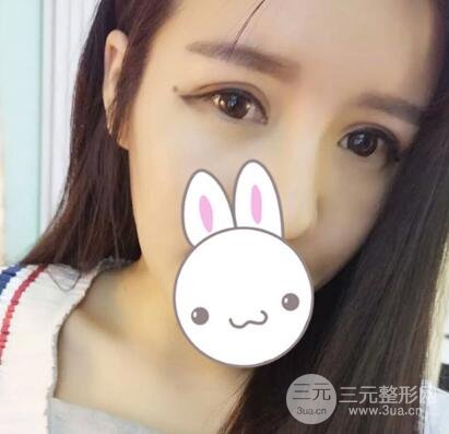 割雙眼皮失敗變幾層眼皮成功修復(fù)價格和案例分享