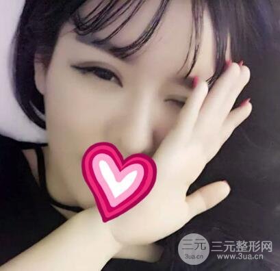 割雙眼皮失敗變幾層眼皮成功修復(fù)價格和案例分享