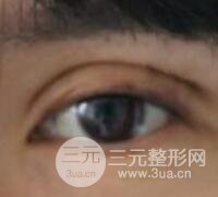 割雙眼皮失敗變幾層眼皮成功修復(fù)價(jià)格和案例分享