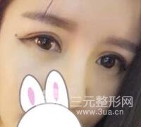 割雙眼皮失敗變幾層眼皮成功修復(fù)價(jià)格和案例分享