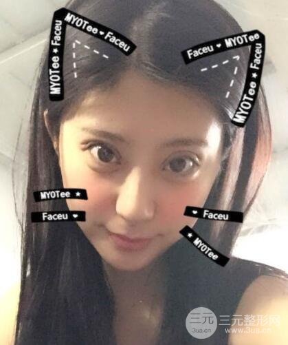 成都嬌點(diǎn)李競(jìng)割雙眼皮價(jià)格和案例