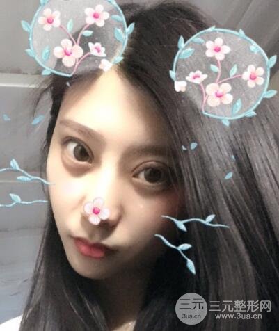 成都嬌點(diǎn)李競(jìng)割雙眼皮價(jià)格和案例