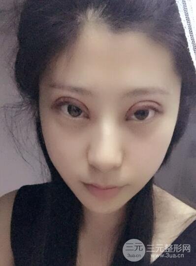成都嬌點(diǎn)李競(jìng)割雙眼皮價(jià)格和案例