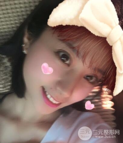 成都嬌點(diǎn)李競(jìng)割雙眼皮價(jià)格和案例