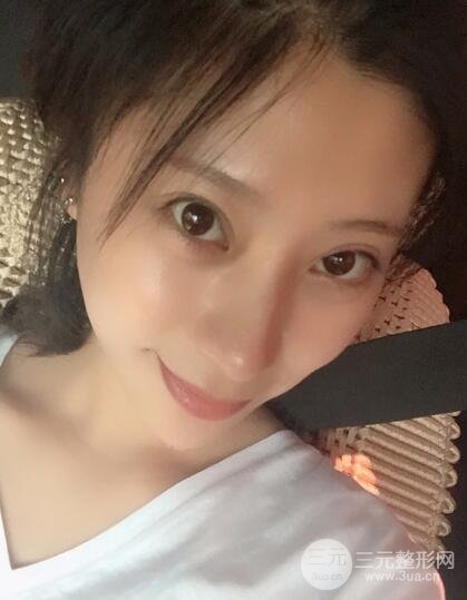 成都嬌點(diǎn)李競(jìng)割雙眼皮價(jià)格和案例