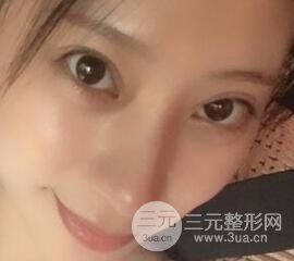 成都嬌點李競割雙眼皮價格和案例