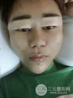 切開雙眼皮+自體脂肪填充全臉真實(shí)案例分享，并附上前后對比圖片~