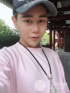 切開雙眼皮+自體脂肪填充全臉真實(shí)案例分享，并附上前后對比圖片~