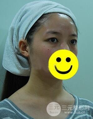 內(nèi)切祛眼袋手術(shù)真實(shí)案例，并附上前后對比圖片