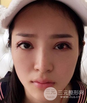 武漢葉子葉飛醫(yī)生給我做的切開雙眼皮手術(shù)，分享一下前后對(duì)比圖