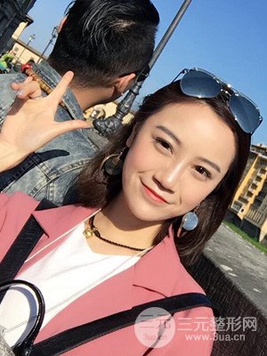 假體隆鼻+耳軟骨墊鼻尖真實(shí)案例，并附上前后對(duì)比圖~