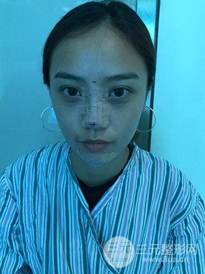 假體隆鼻+耳軟骨墊鼻尖真實(shí)案例，并附上前后對(duì)比圖~