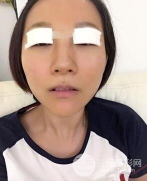 武漢葉子竺湘云給我做的切開雙眼皮手術(shù)，分享一下前后對比圖片