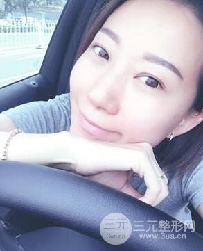 武漢葉子竺湘云給我做的切開雙眼皮手術(shù)，分享一下前后對比圖片