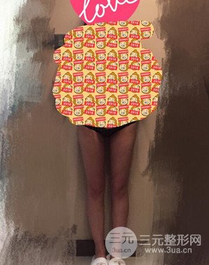 大腿吸脂前后對比圖以及恢復(fù)過程分享——武漢葉子竺湘云醫(yī)生做的