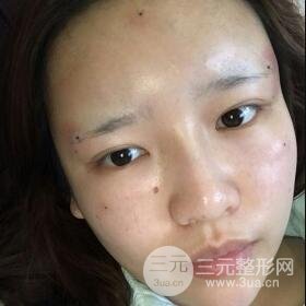 成都嬌點整容醫(yī)院李競做全臉脂肪填充案例