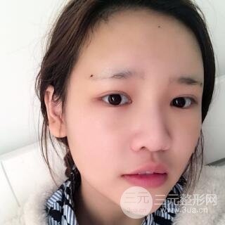 成都嬌點整容醫(yī)院李競做全臉脂肪填充案例