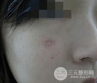 激光祛疤非手術(shù)真實果圖案例