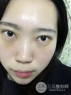 內(nèi)切祛眼袋手術(shù)真實案例，武漢天申胡麗醫(yī)生做的