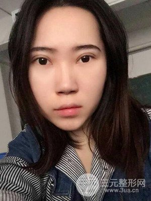 內(nèi)切祛眼袋手術(shù)真實案例，武漢天申胡麗醫(yī)生做的