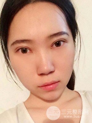 內(nèi)切祛眼袋手術(shù)真實案例，武漢天申胡麗醫(yī)生做的