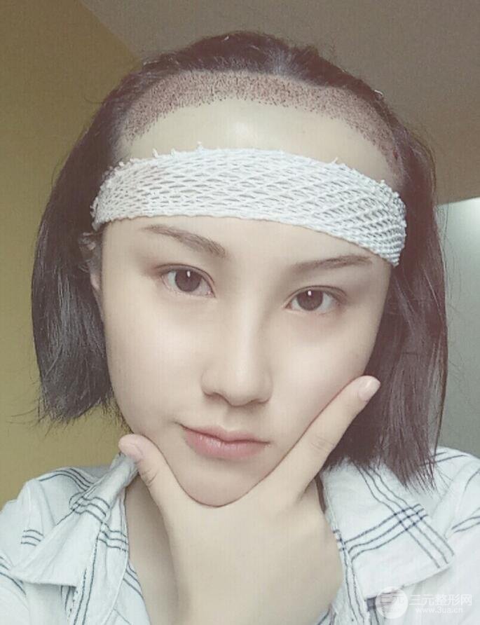 武漢天申胡麗醫(yī)生發(fā)際線種植真實案例，并附上前后對比圖片